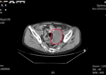 工地意外僅喊腿痛　檢查竟是腸系膜大出血 急診醫師揭「姿勢痛」致命警訊