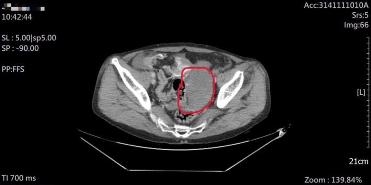 工地意外僅喊腿痛　檢查竟是腸系膜大出血 急診醫師揭「姿勢痛」致命警訊
