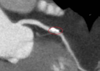 影音/中部首例「生物適應性支架」  助血管恢復彈性、降低再狹窄風險