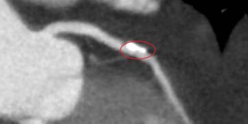 影音/中部首例「生物適應性支架」  助血管恢復彈性、降低再狹窄風險