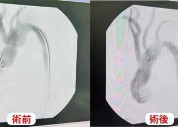 高風險主動脈弓病變新解方　東港安泰醫院完成新型微創支架治療