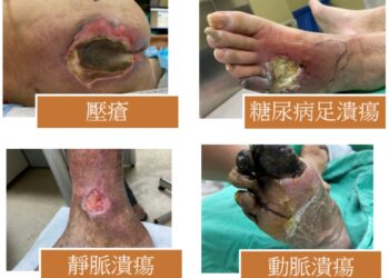 生物膜致慢性傷口癒合不良 儘早尋求專業醫療評估