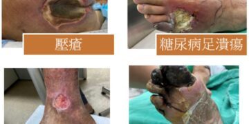 生物膜致慢性傷口癒合不良 儘早尋求專業醫療評估