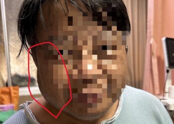 洗腎越洗連右臉都腫 心臟外科突破阻塞靜脈、成功打通洗腎血管通路