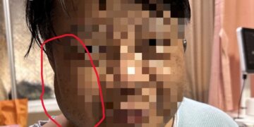 洗腎越洗連右臉都腫  心臟外科突破阻塞靜脈、成功打通洗腎血管通路