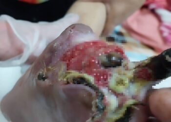 婦剪趾甲竟變截掉兩根腳趾 經歷清創靠中醫雷射針灸重新站起來