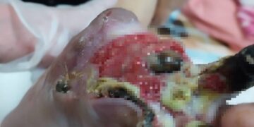 婦剪趾甲竟變截掉兩根腳趾 經歷清創靠中醫雷射針灸重新站起來