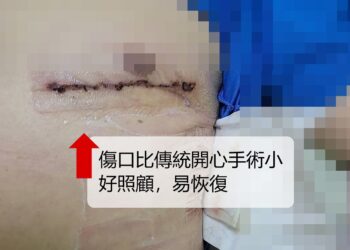 食道重建患者手術挑戰高 安泰醫院微創心臟繞道助提早康復