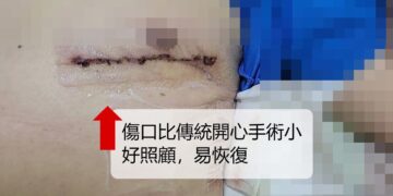 食道重建患者手術挑戰高 安泰醫院微創心臟繞道助提早康復